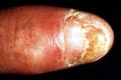 Onychodystrophy of the thumbnail.
