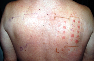 terbinafine photoallergy confirmed by photo patch test